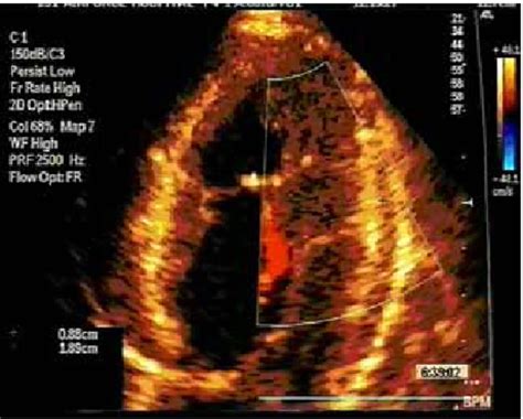 Two Dimensional Echocardiogram Four Chamber Apical View The Colour