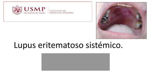 Lupus Eritematoso Sist Mico Viviana Lopez Miranda Udocz