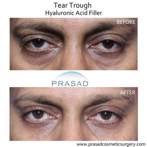 Under Eye Filler Before And After Photos Prasad Cosmetic Surgery NY