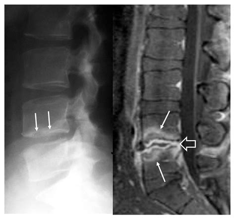 A 34 Year Old Man With Brucella Spondylodiscitis The Initial Lateral