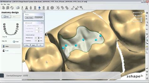 How To Make An Inlay With 3shape Dental System Maptec Dubai And