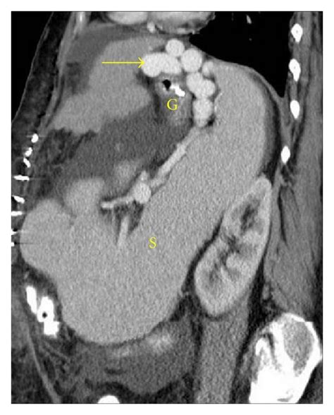 Splenomegaly In A Cirrhotic Patient With Portal Hypertension Sagittal Download Scientific