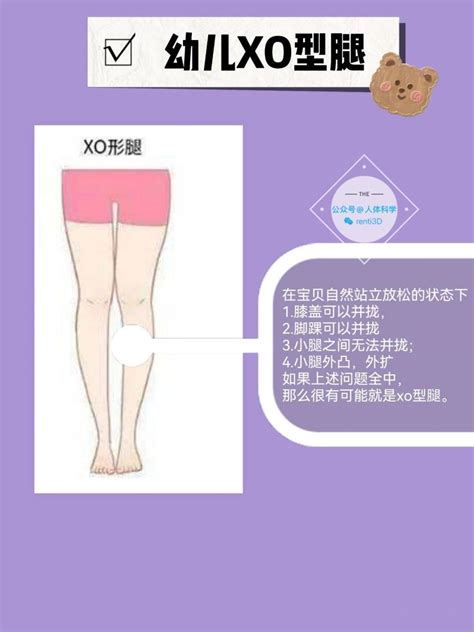 【儿童体态】如何区分孩子腿型，xo型腿 知乎