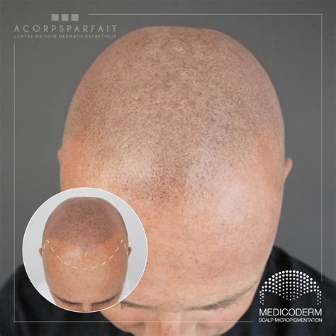 Solution La Calvitie Par Micropigmentation Capillaire Namur