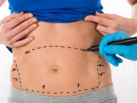 Tummy Tuck Cost How Much Cost