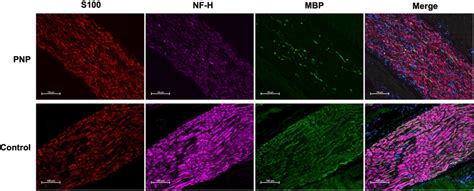 Immunofluorescent Staining S100 Positive Schwann Cells Red