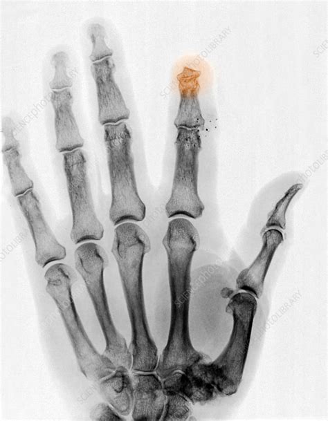 Finger Amputation X Ray Stock Image C Science Photo Library