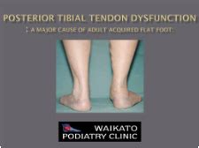 Posterior Tibial Tendon Dysfunction PTTD Waikato Podiatry