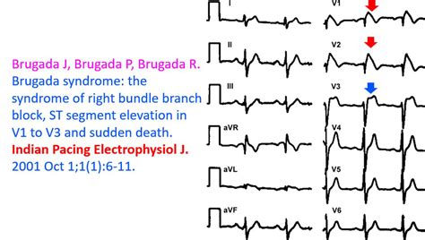 Brugada Syndrome Diagnosis And Risk Stratification All About