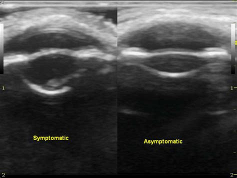 Ocular Ultrasound Cataract And Retinal Detachment Image