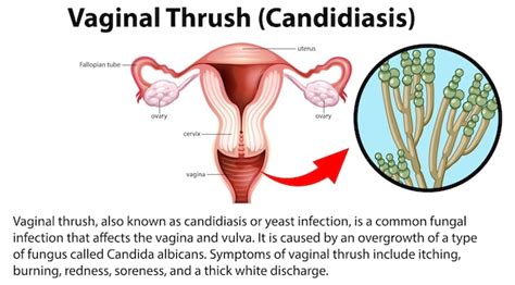 Infographie Sur La Candidose Vaginale Avec Explication Vecteur Gratuite