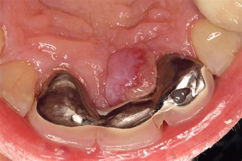 Oral Pyogenic Granuloma