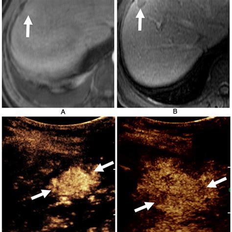 Ceus Li Rads Hcc In A Year Old Man With Nash Cirrhosis Arterial