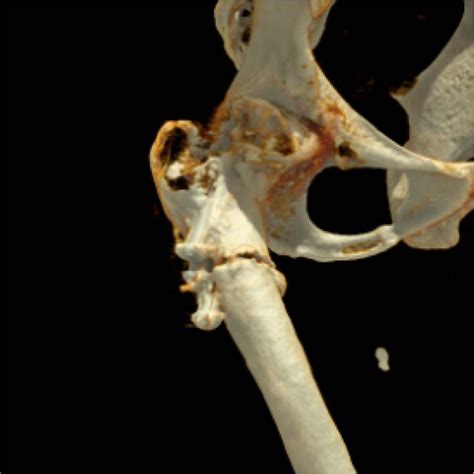 Three-dimensional reconstruction of computer tomography shows the ... 