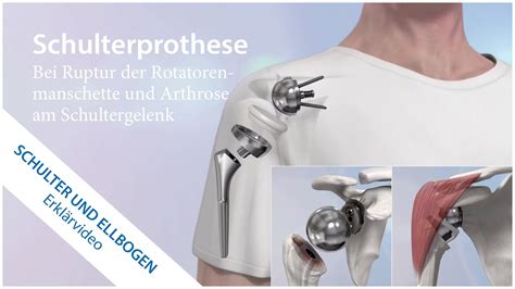 Schulterprothese Bei Arthrose Am Schultergelenk Youtube