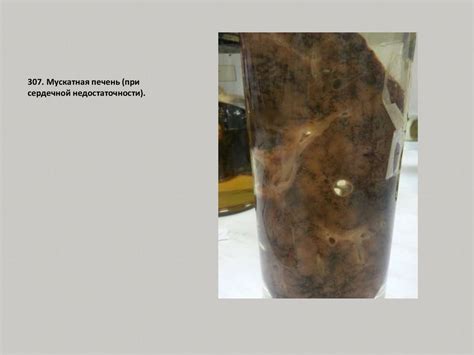 Гипертоническая болезнь - презентация онлайн