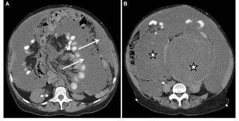 LearningRadiology Pseudomyxoma Peritonei 55 OFF