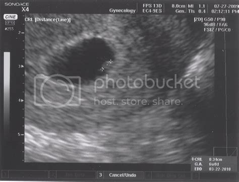 6 week ultrasound - BabyGaga