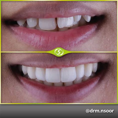 Before and After Teeth Straightening • Synergy Dental Clinics