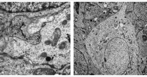 Electron microscopy of the tumor (uranyl acetate and lead citrate ...