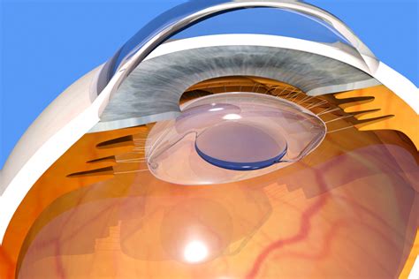 Panoptix Trifocal Lens Uses Of Panoptix Trifocal Lens