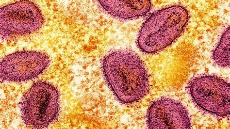 First UK Case Of Deadly Strain Of Mpox Virus Detected United Kingdom