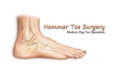 Hammer Toe Surgery Modern Day Toe Operation Foot And Ankle Clinic