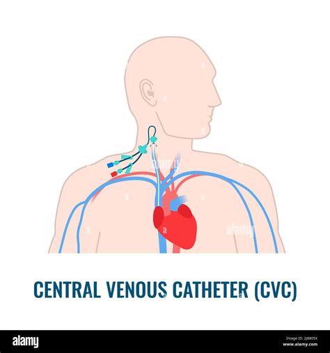 Cateter Venoso Central Dibujo