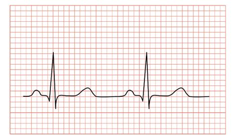 filenormal ecg svg wikimedia commons