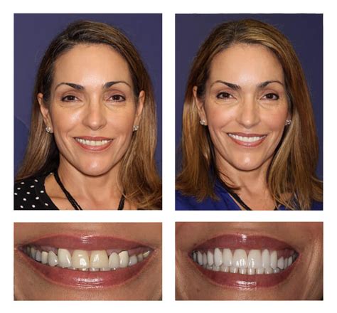 Cosmetic Dentist Port St Lucie Fl Vero Dental Spa