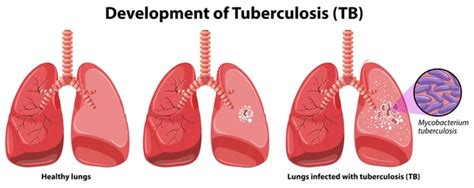 Human Lungs With Tuberculosis — Stock Vector © Interactimages 116839946