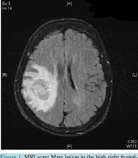 Figure 1 From Malignant Cerebral Edema Secondary To Gliadel Wafers In The Early Postsurgical