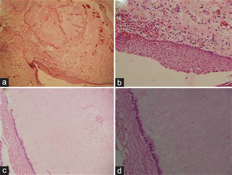 Suprasellar Dermoid Cyst Associated With Colloid Cyst Of The Third