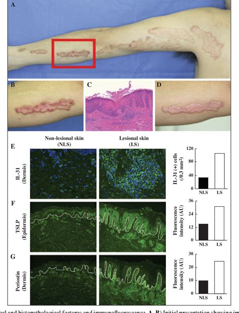 Figure 1 From Linear Porokeratosis With Severe Itch Accompanied By