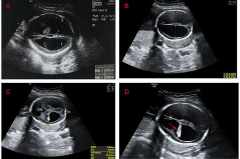 Transabdominal View Of The Fetal Brain A Ultrasound Image Of The