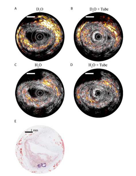 Intravascular Imaging Photoacoustic And Ultrasound Catheters For