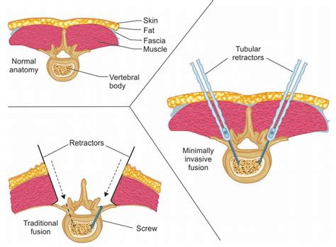 A And B Open Vs Minimally Invasive Surgery Technique For Pedicle Screw Download Scientific