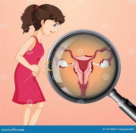 Ovarian Cancer Ovarian Carcinoma Germ Cell Tumor Sex Cord Stromal Tumor Stock Image