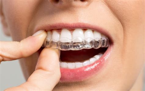 How Do They Work Invisible Braces Pacific West Dental Blog