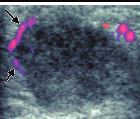 Transverse Power Doppler Sonogram Obtained In A 44 Year Old Woman Shows Download Scientific