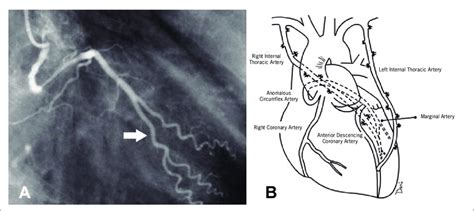 Coronary angiography showing the circumflex artery originating from the ...