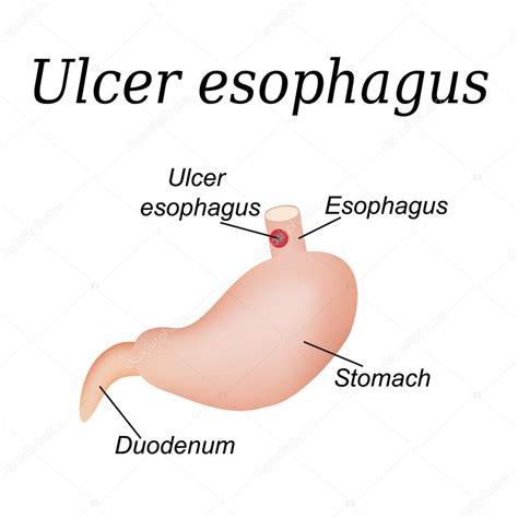 Úlcera de esófago afectada Úlcera de esófago Ilustración vectorial