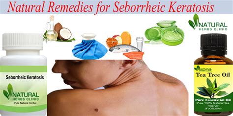 Seborrheic Keratosis Removal At Home