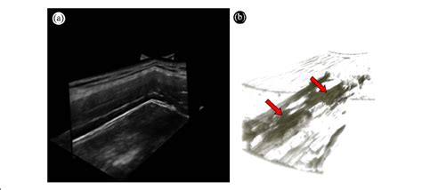 3D rendering of a MTrP. (a) Multiplanar view of a 3D volume of the ...