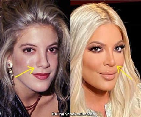 Tori Spelling Plastic Surgery Comparison Photos