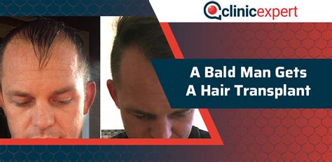 A Bald Man Gets a Hair Transplant | ClinicExpert