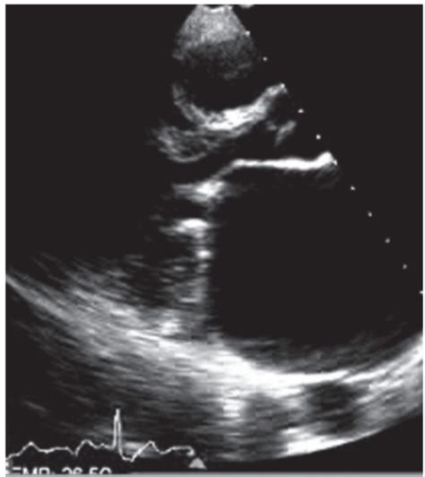 Estenose Mitral Reum Tica Atualiza O Nos Crit Rios Ecocardiogr Ficos