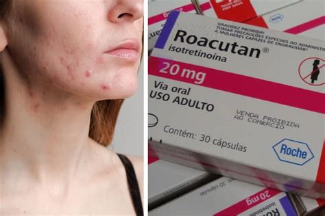 Roacutan Para Que Serve E Efeitos Colaterais