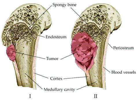 Development of a bone tumor: (I) Destruction of a bone site by a tumor ...