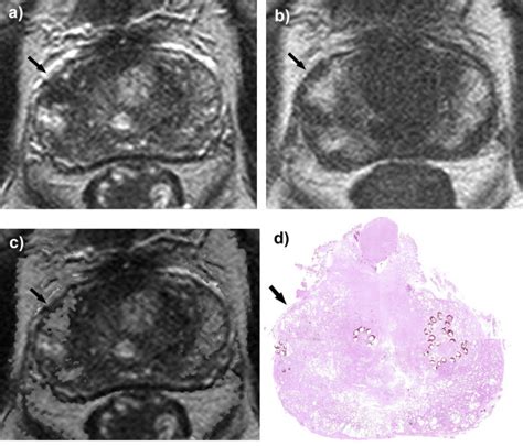 High Specificity Of T1 T2 Weighted Registered Imaging In A 74 Year Old